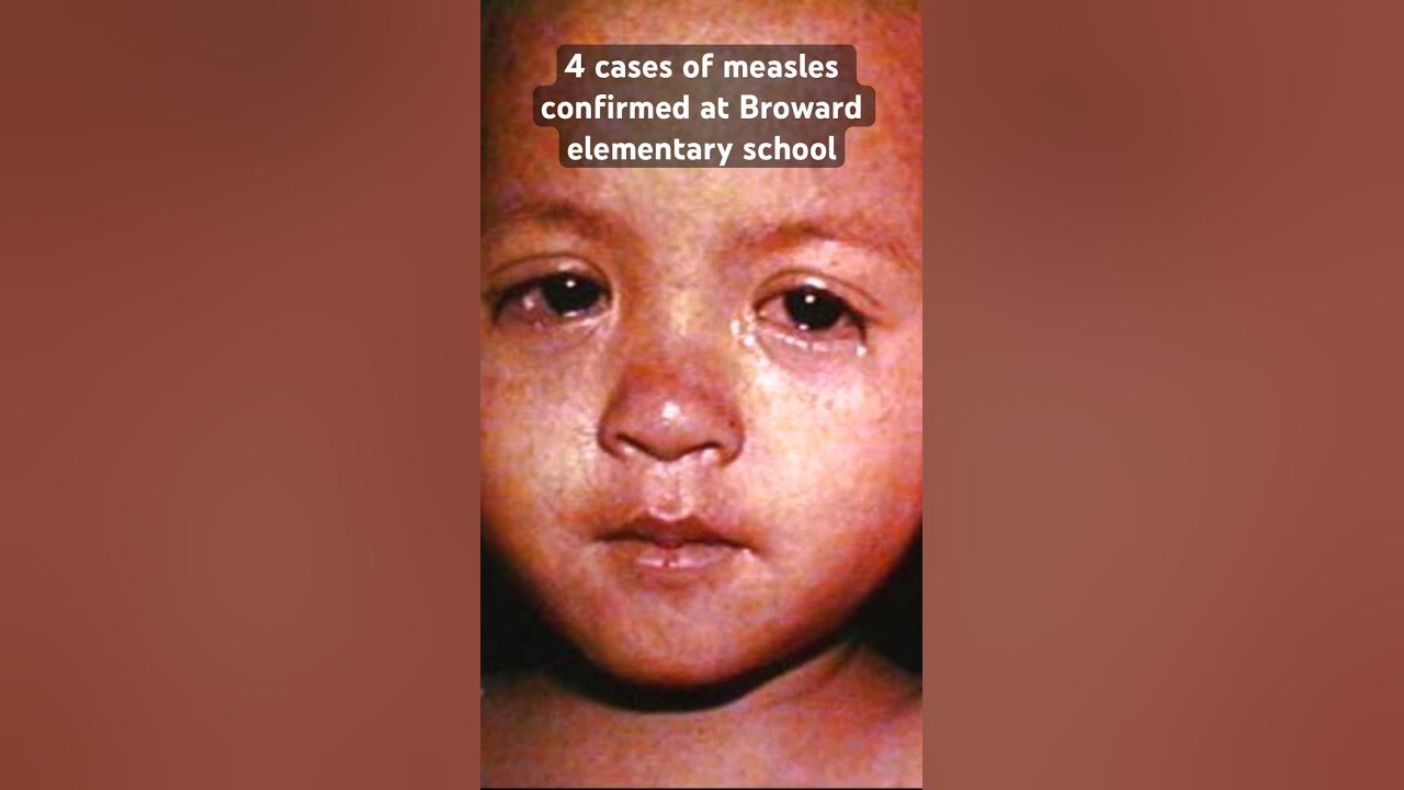 Four cases of measles were confirmed at an elementary school in #browardcounty, officials say