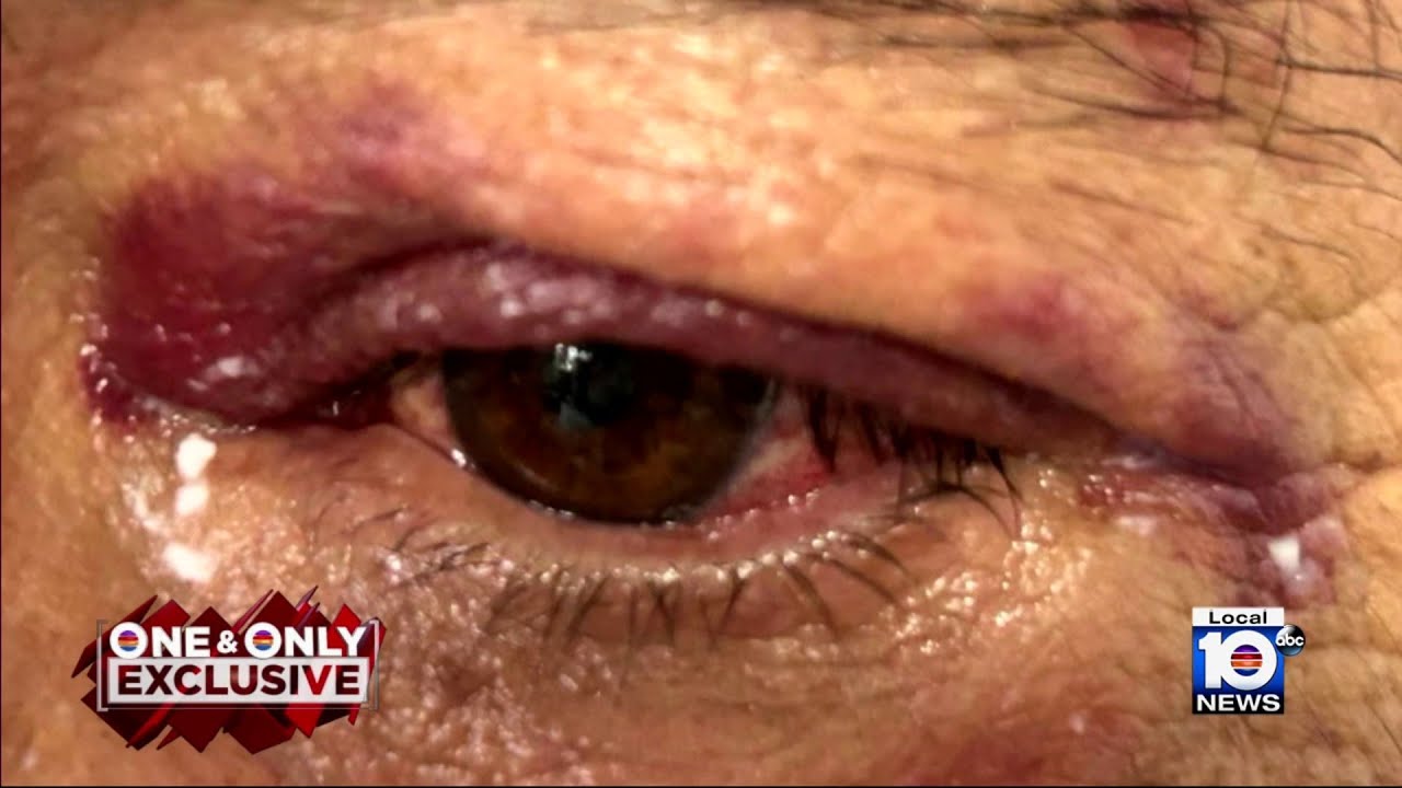 Rabbi speaks to Local 10 after being beaten while walking home from Lauderhill synagogue