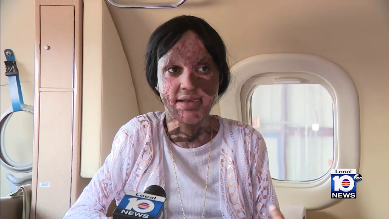 13-year-old arrives in Fort Lauderdale after receiving 26 surgeries from house fire in Jamaica