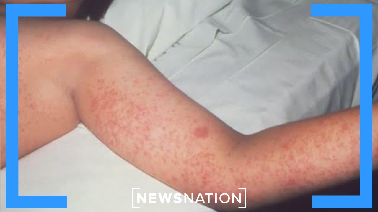 Florida dealing with growing measles outbreak | NewsNation Now